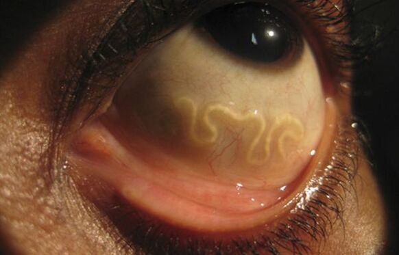 Червеят Loa Loa живее в човешкото око и причинява слепота